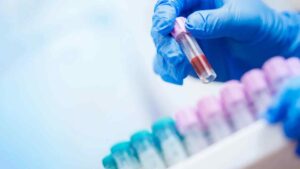 exame de sangue Alzheimer