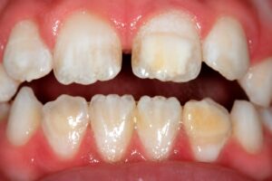 Imagem mostrando dentes com hipomineralização molar incisivo, evidenciando opacidades e defeitos no esmalte dentário em criança.