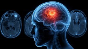 Ressonância magnética de neurocisticercose autóctone mostrando escólex em lesão cerebral cística, Espanha