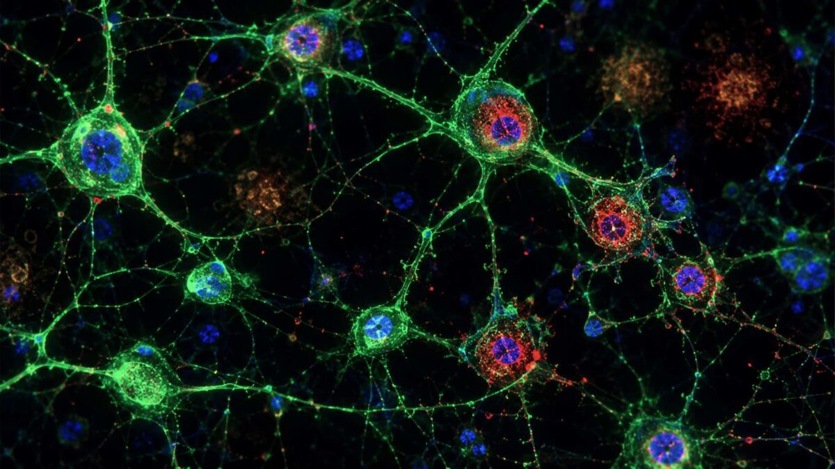 Imagem de microscopia de neurônios mostrando danos no DNA, representando o efeito do KCL-286 no Alzheimer.