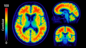 Imagem de PET amiloide cerebral com escala de cores mostrando captação do traçador em regiões típicas do Alzheimer, ilustrando o conceito da escala Centiloid.