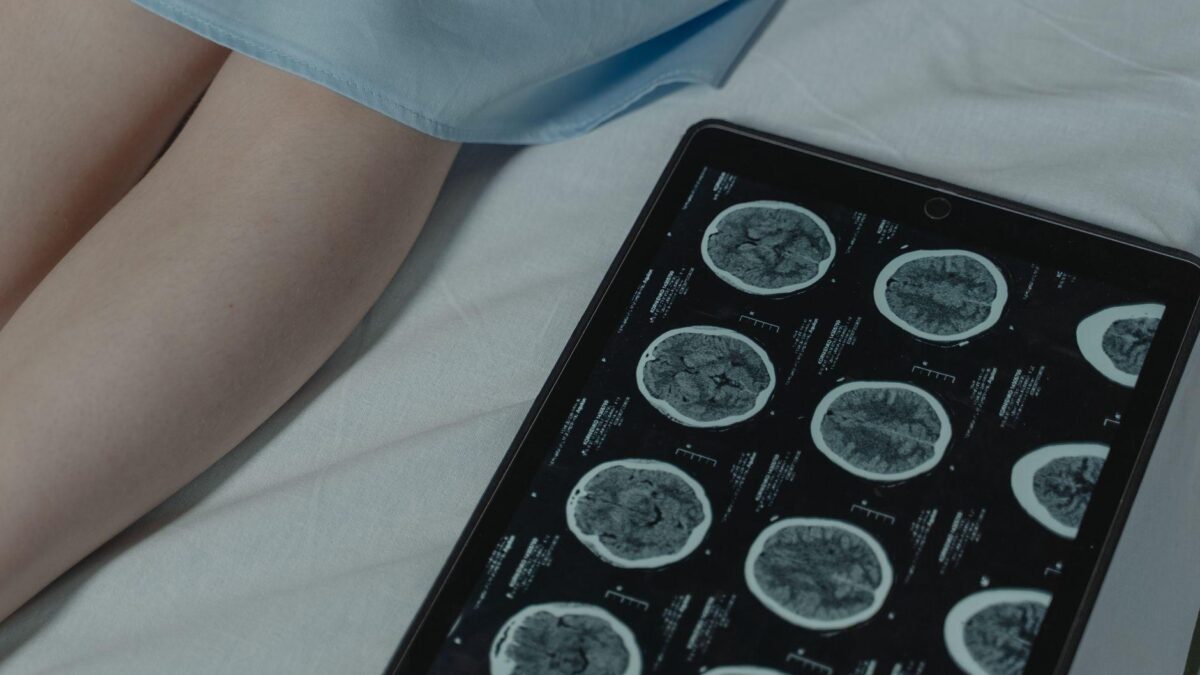 Exame de imagem cerebral do estudo sobre gene AQP4, Alzheimer e a influência do sono.