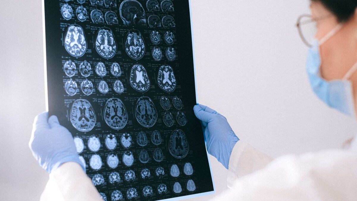 Exame de imagem cerebral de mulher idosa ilustra estudo sobre terapia hormonal e Alzheimer