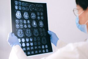 Exame de imagem cerebral de mulher idosa ilustra estudo sobre terapia hormonal e Alzheimer