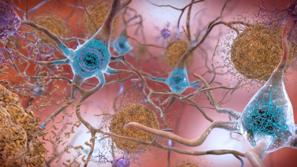 Ilustração de neurônios com placas de proteína amiloide e emaranhados de tau, alterações típicas do Alzheimer