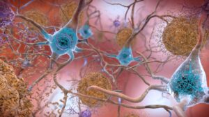 Ilustração de neurônios com placas de proteína amiloide e emaranhados de tau, alterações típicas do Alzheimer