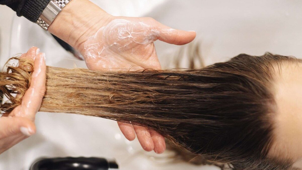 Pessoa com alopecia areata grave mostrando falhas no cabelo, condição tratada com upadacitinib em estudo de fase 3