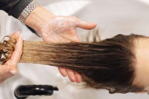 Pessoa com alopecia areata grave mostrando falhas no cabelo, condição tratada com upadacitinib em estudo de fase 3
